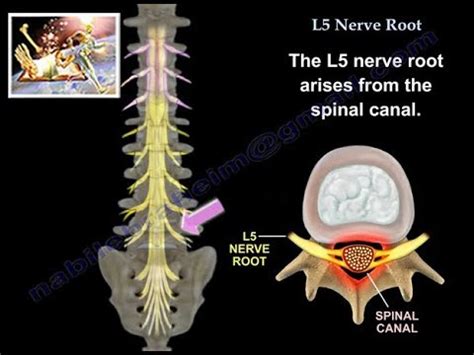 right l5 nerve root impingement